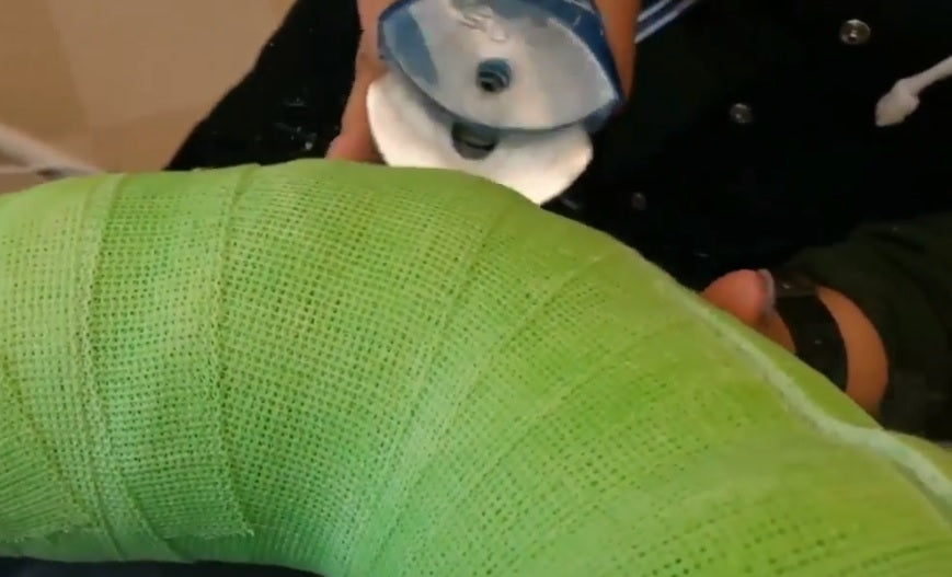Cast Removal Anxiety : Fear the Cast Saw no More!