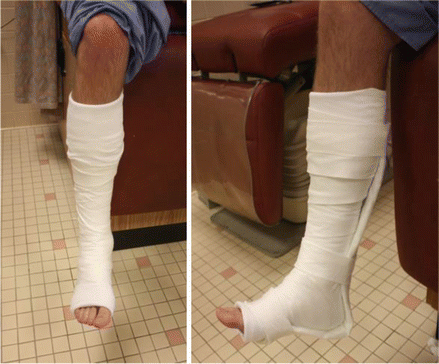 Fiberglass Posterior Splint Sprained Ankle Leg Kit - OrthoTape - OrthoTape.com