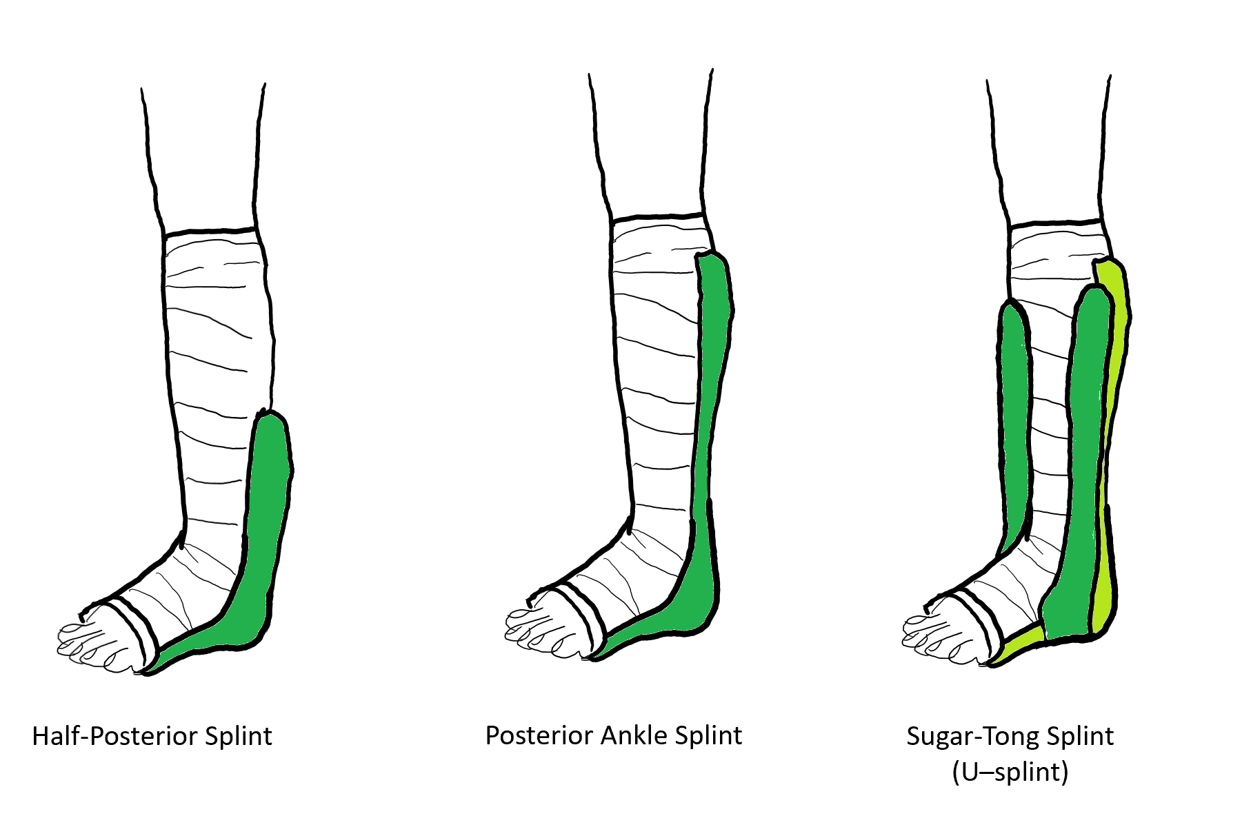 Fiberglass Stirrup Splint Sprained Ankle Splint Kit - OrthoTape - OrthoTape.com
