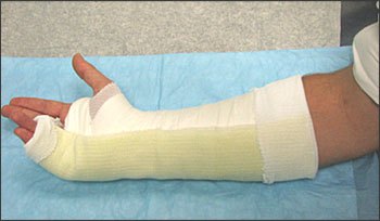 Ulnar Gutter Splint