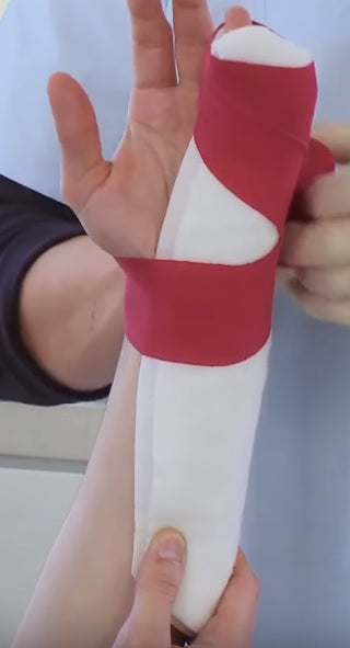 Boxers Fracture Cast